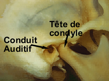 articulation mandibule crne A T M, avec acouphnes